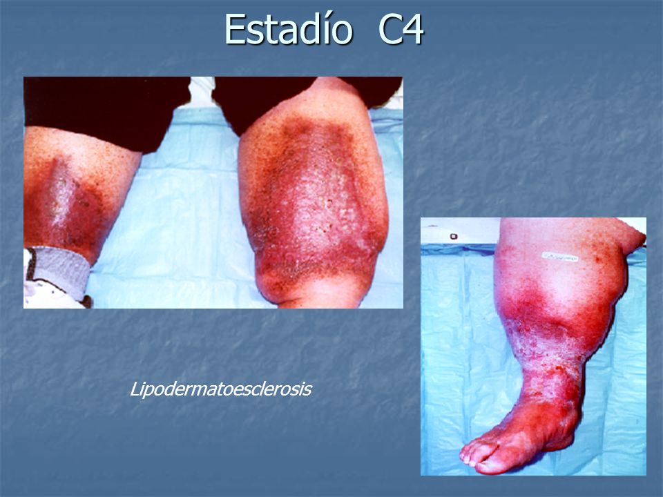 Sindrome sicca ipo c3 c4 flight